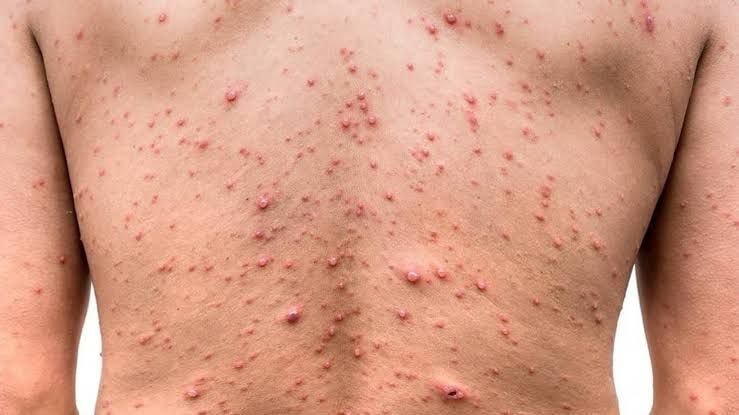 *Sector Salud confirma caso positivo a Viruela del Mono*